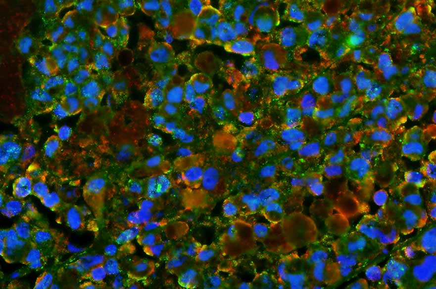 Image of stained malignant melanoma tissue