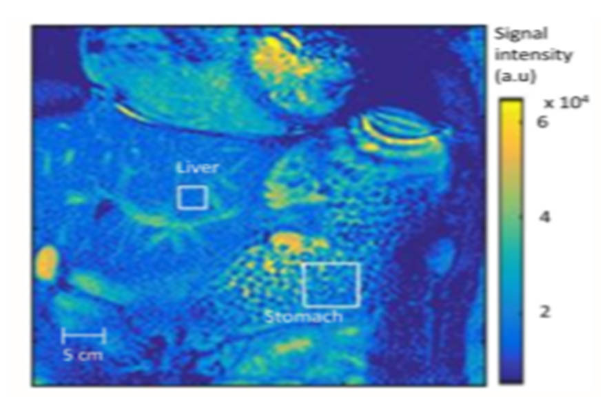 MRI scan showing bubbles in stomach