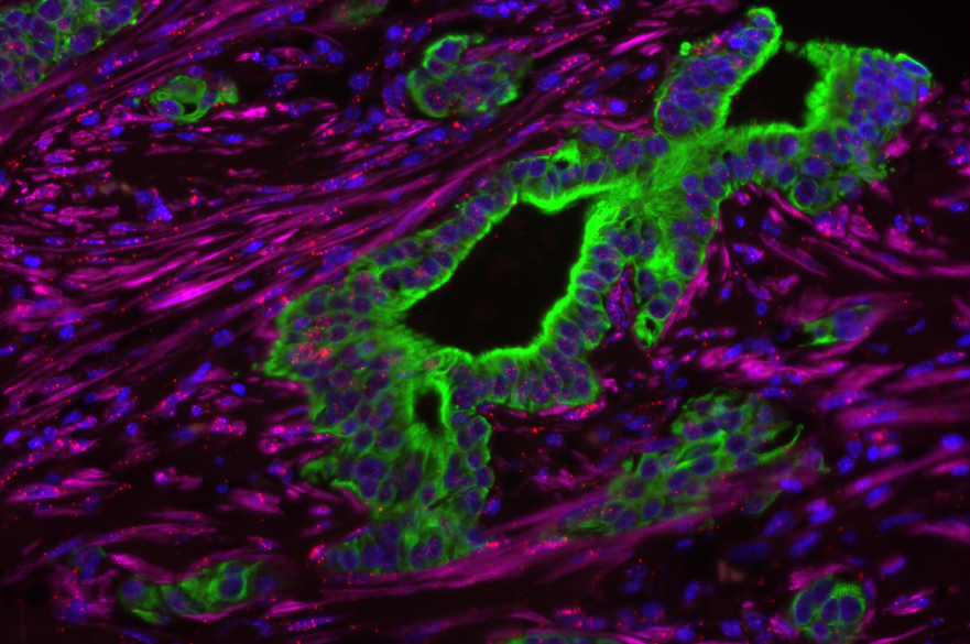 patient sample diagnosed with stage 3 pancreatic cancer.