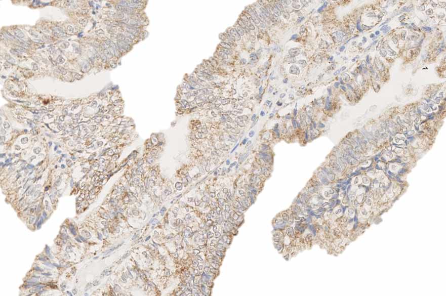 Slide image of ovarian cancer cells