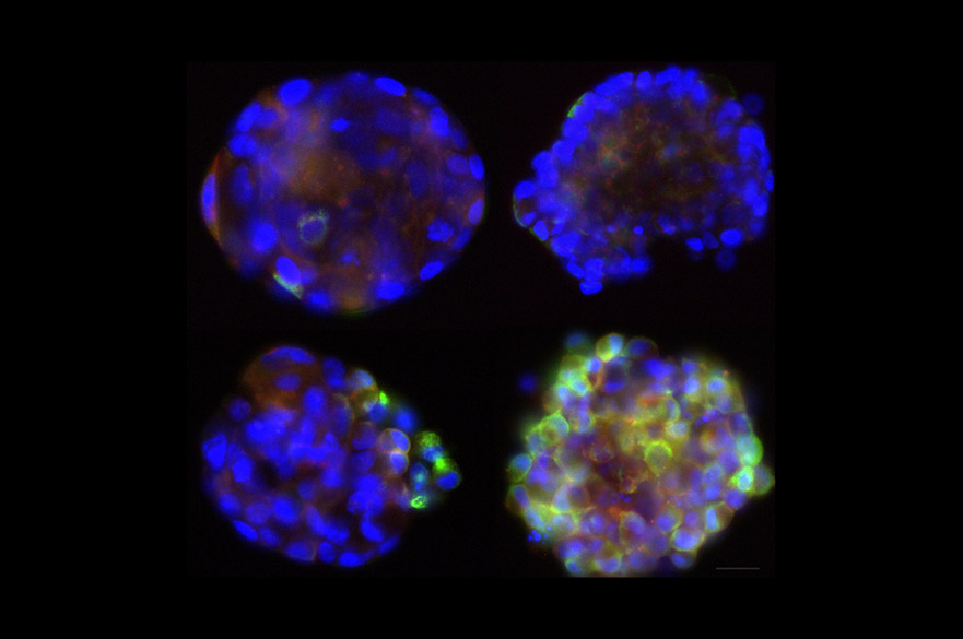 Prostate cancer cells