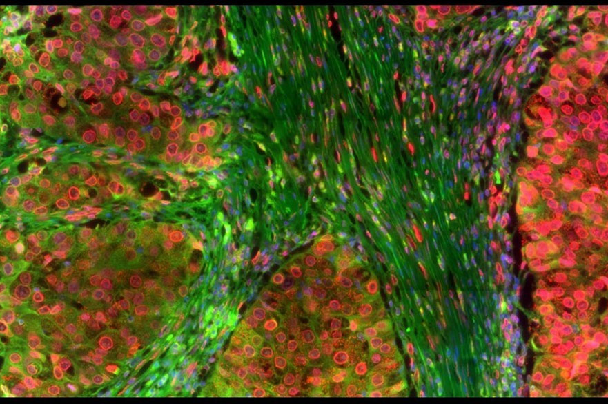 This striking microscopic image reveals the protein, Tau (shown in red) within breast cancer tissue. 