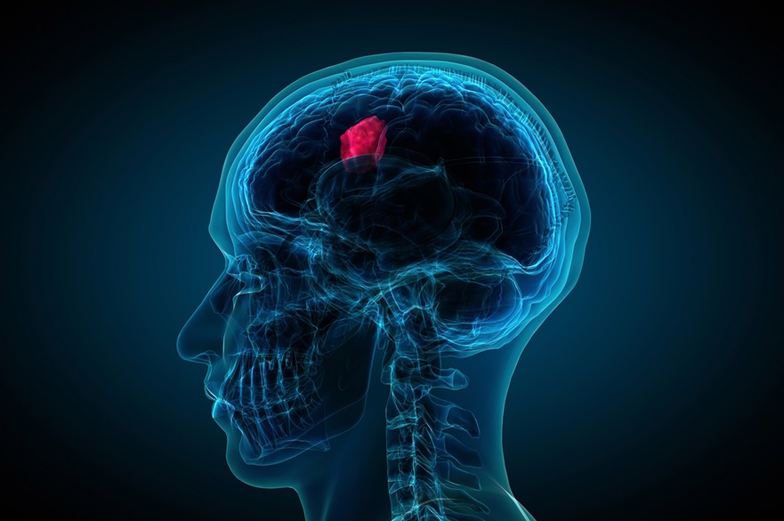 Brain tumour